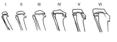 Diagram depicting radiographic changes in infantil