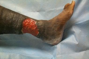 Vascular ulcers. Venous ulcer with characteristic 