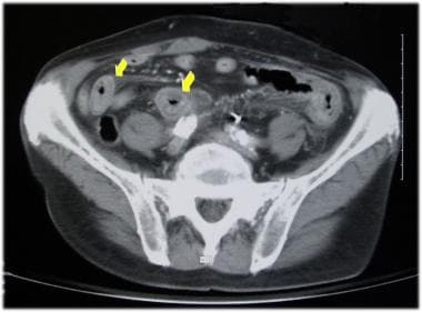 CT scan (with contrast) of nonocclusive mesenteric