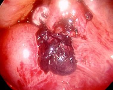 Laparoscopic picture of an ampullary ectopic pregn