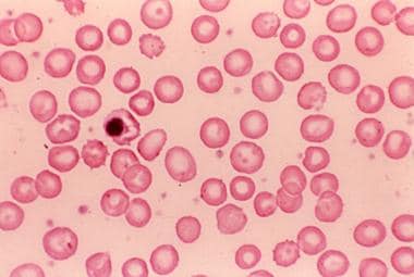 Peripheral blood smear in a child with splenectomy