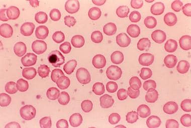 hemolytic disease of the newborn blood smear