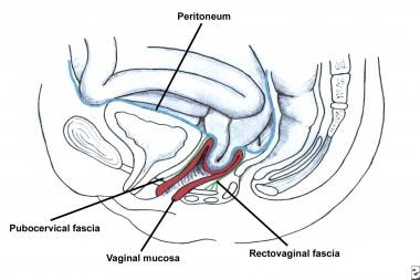 Enterocele and massive vaginal eversion. Early ent