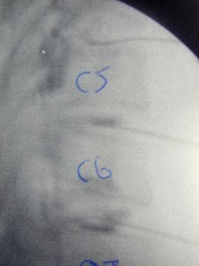 Cervical discography. Lateral fluoroscopic image. 