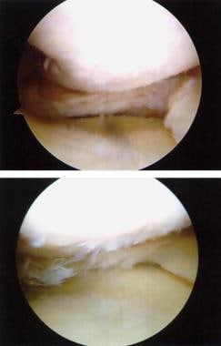 hip osteoarthritis medscape