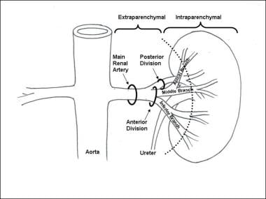 Schematic of renal artery anatomy. The aneurysm lo