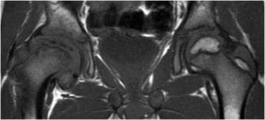 Legg-Calve-Perthes Disease in Emergency Medicine Workup: Imaging Studies