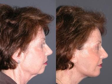 Before and after biplanar face lift with lower eye