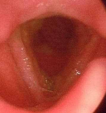 acute laryngitis