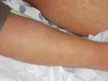 Urticarial and erythematous rash. 