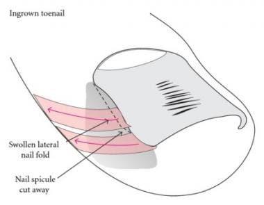 Ingrown Nails: Background, Pathophysiology, Etiology