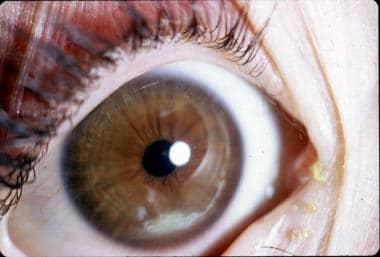 Erosion and scarring of the inferior cornea due to