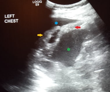 Left chest ultrasound in this patient demonstrated
