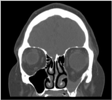 Coronal computed tomograph of silent sinus syndrom