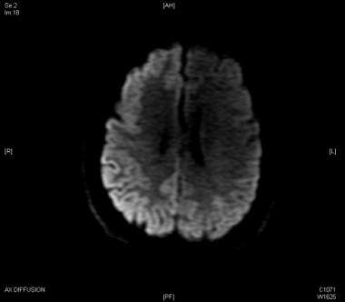 MRI axial diffusion weighted image: Cortical ribbo