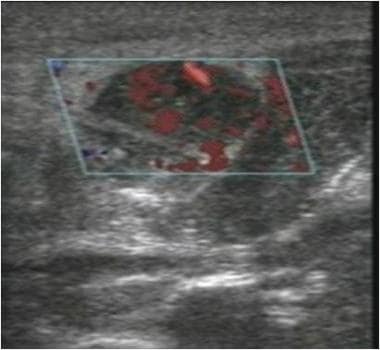 Ultrasound image of a lymph node demonstrating col