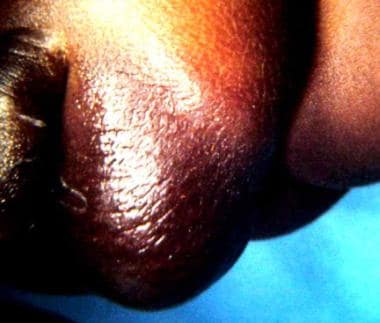 Erythematous edematous left scrotum in 2-month-old