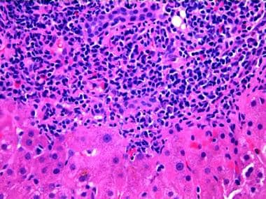 hepatitis c liver histology