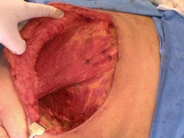 Postoperative view after bilateral prophylactic mastectomy and