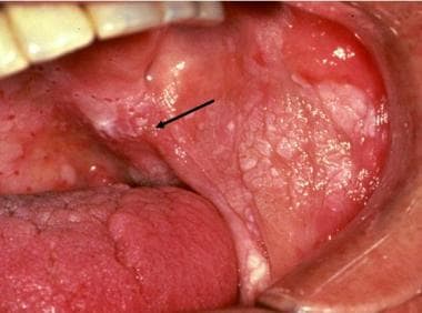 speckled leukoplakia