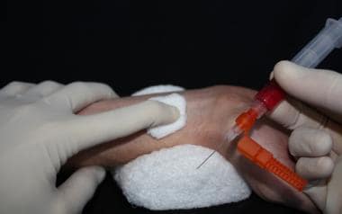 Removal of needle from radial artery puncture site