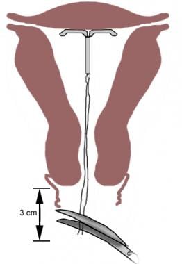 Trimming the IUD strings to 3-4 cm. 