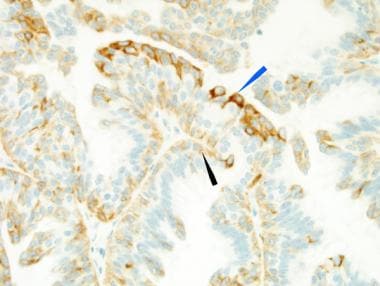 CK 5/6 shows expression in both the myoepithelial 