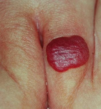 Benign vulvar lesions. Hemangioma. 