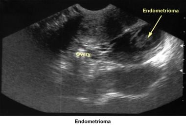 Infertility. Endometrioma. Image courtesy of Jairo
