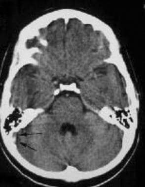 A 23-year-old woman with headache. CT scan demonst