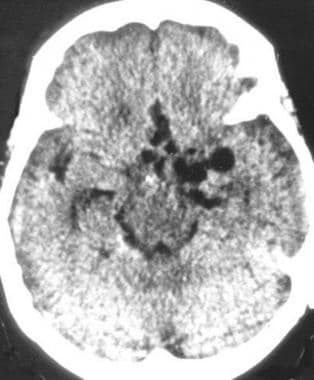 Nonenhanced CT image of the brain shows large cere