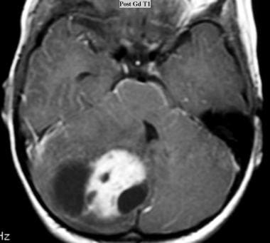 Juvenile pilocytic astrocytoma (JPA). Axial T1-wei