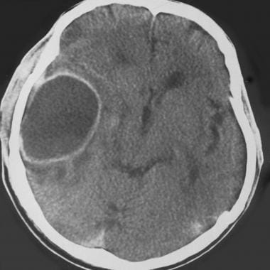 Abscess in a patient with bacterial meningitis. Th