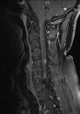 Spinal MRI: Sagittal STIR (short T1 inversion reco