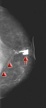 Craniocaudal mammogram obtained in the patient in 