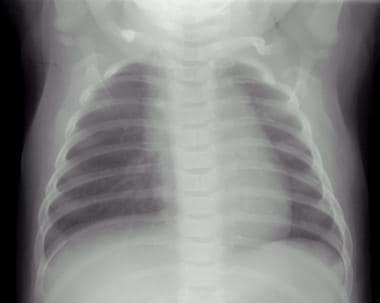 Radiograph of an infant with tetralogy of Fallot a
