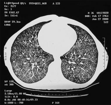 Thoracic histoplasmosis. CT image at the lung base