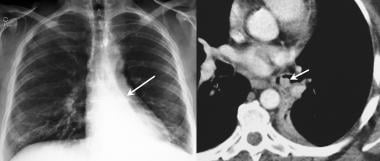 Lung, carcinoid. Right, Chest radiograph (CXR) in 