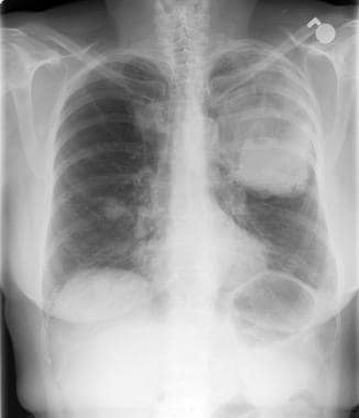 Lung cancer, small cell. Frontal chest radiograph 