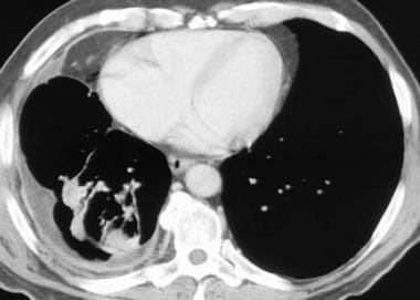 Computed tomography scan in a 71-year-old man with