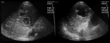 Ultrasonograms in an elderly woman. The images dem