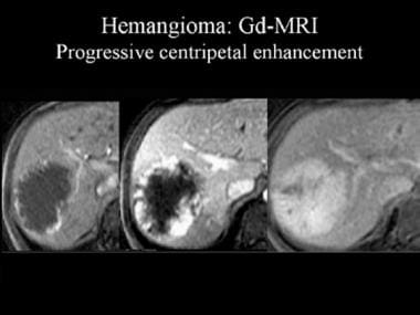 cavernous hemangioma liver ultrasound