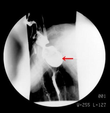 Single spot radiograph from a barium esophagograph