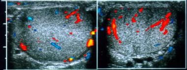 Normal testes. Transverse color Doppler images of 