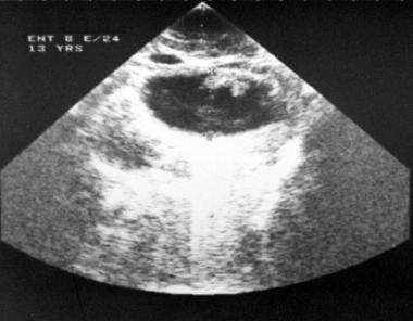 Sonogram demonstrates thyroid cystic lesions in a 