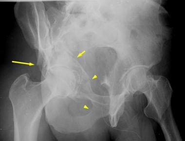 Both-column acetabular fracture. A right obturator