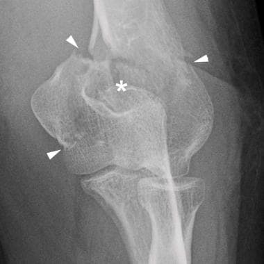 Elbow, fractures and dislocations. Comminuted extr