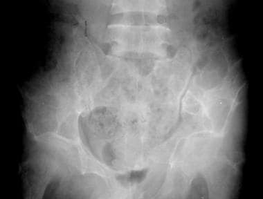 Radiograph of the pelvis in a patient with primary