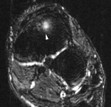 Coronal T2-weighted image of the ankle reveals a c