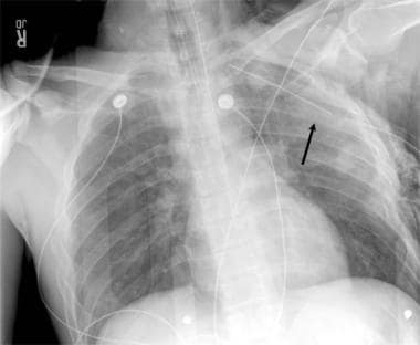 Supine anteroposterior (AP) chest radiograph. This